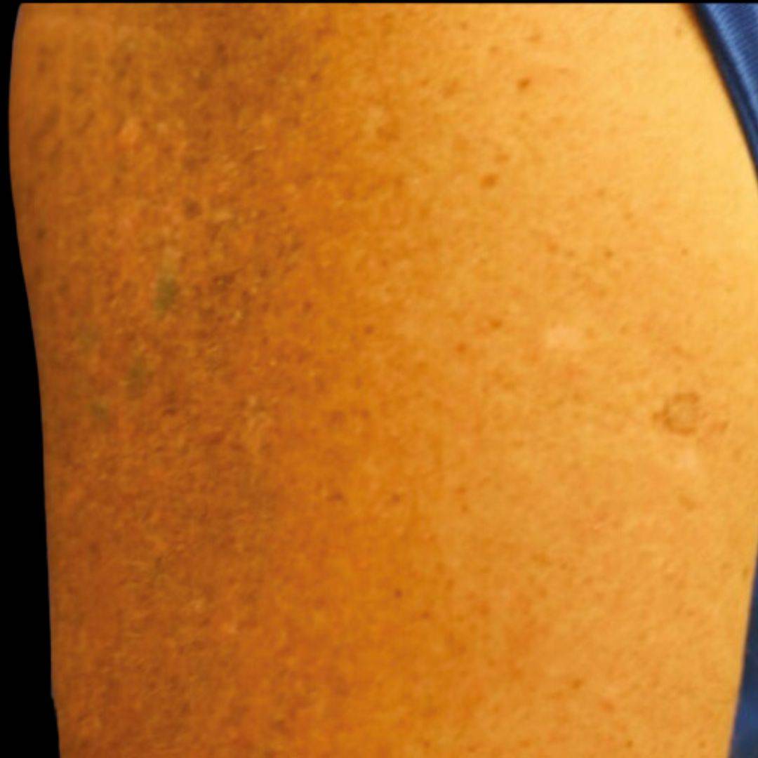 After Charlie reached full tattoo removal in only 3 sessions.