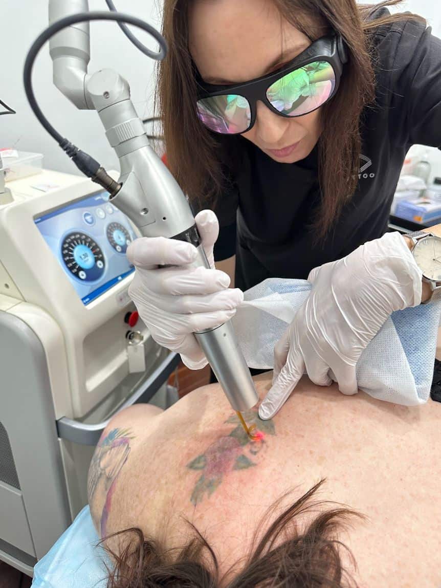 Laser Tattoo Removal Brisbane