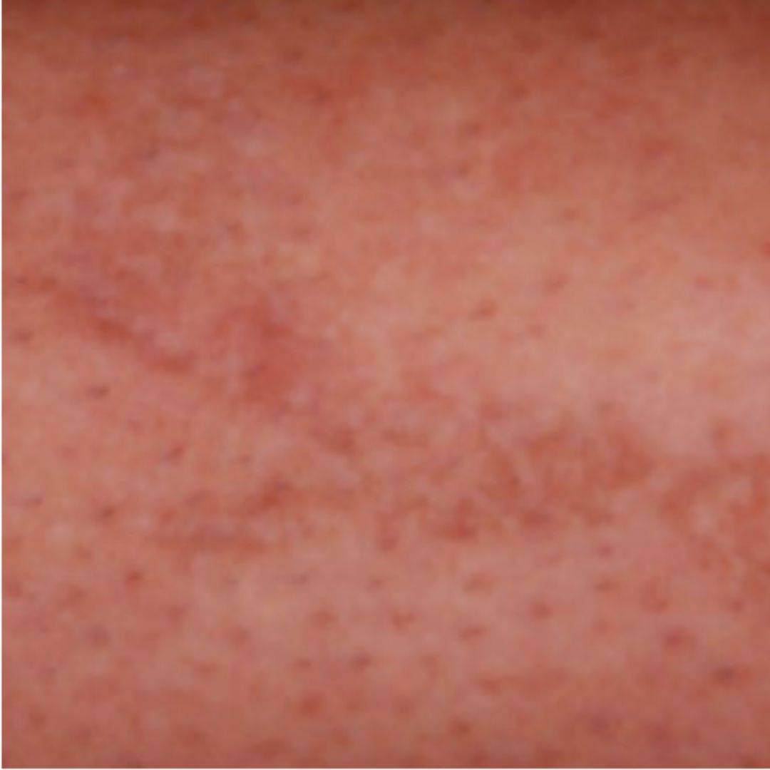 After Jimmy was able to achieve full tattoo removal after just 4 sessions