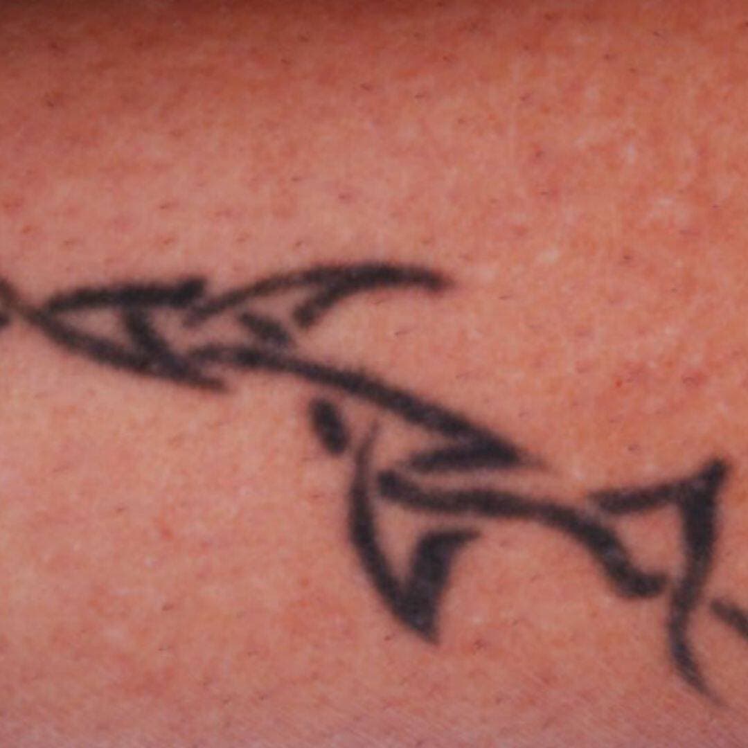 Before Jimmy was able to achieve full tattoo removal after just 4 sessions